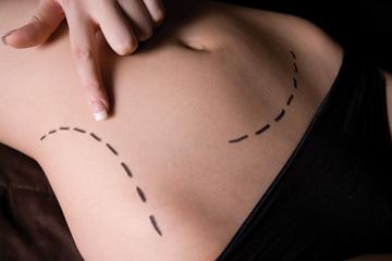 Abdominoplasty